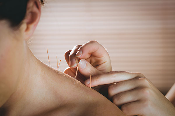 dry needling dry needling